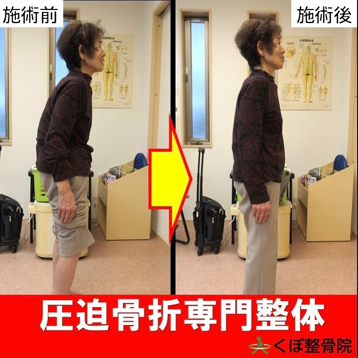 年代別では、70台で最も多く発生する圧迫骨折❗️