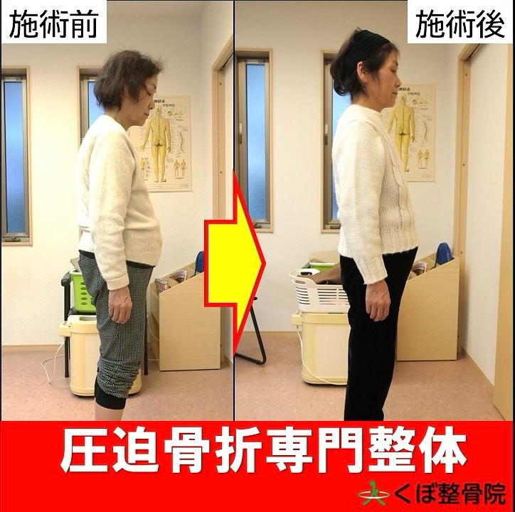 圧迫骨折のなかでも、『いつの間にか骨折』と言われる知らない間...