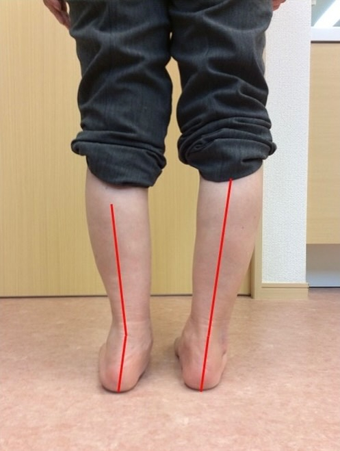 長年、腰痛や膝の痛み、股関節の痛みを患っている方の多くには、...